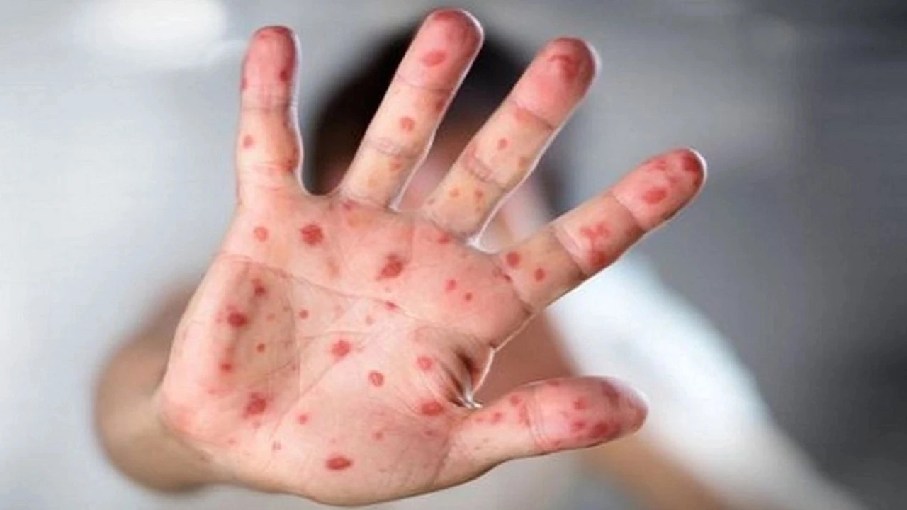 Another 4 die with measles symptoms, 1,242 newly infected