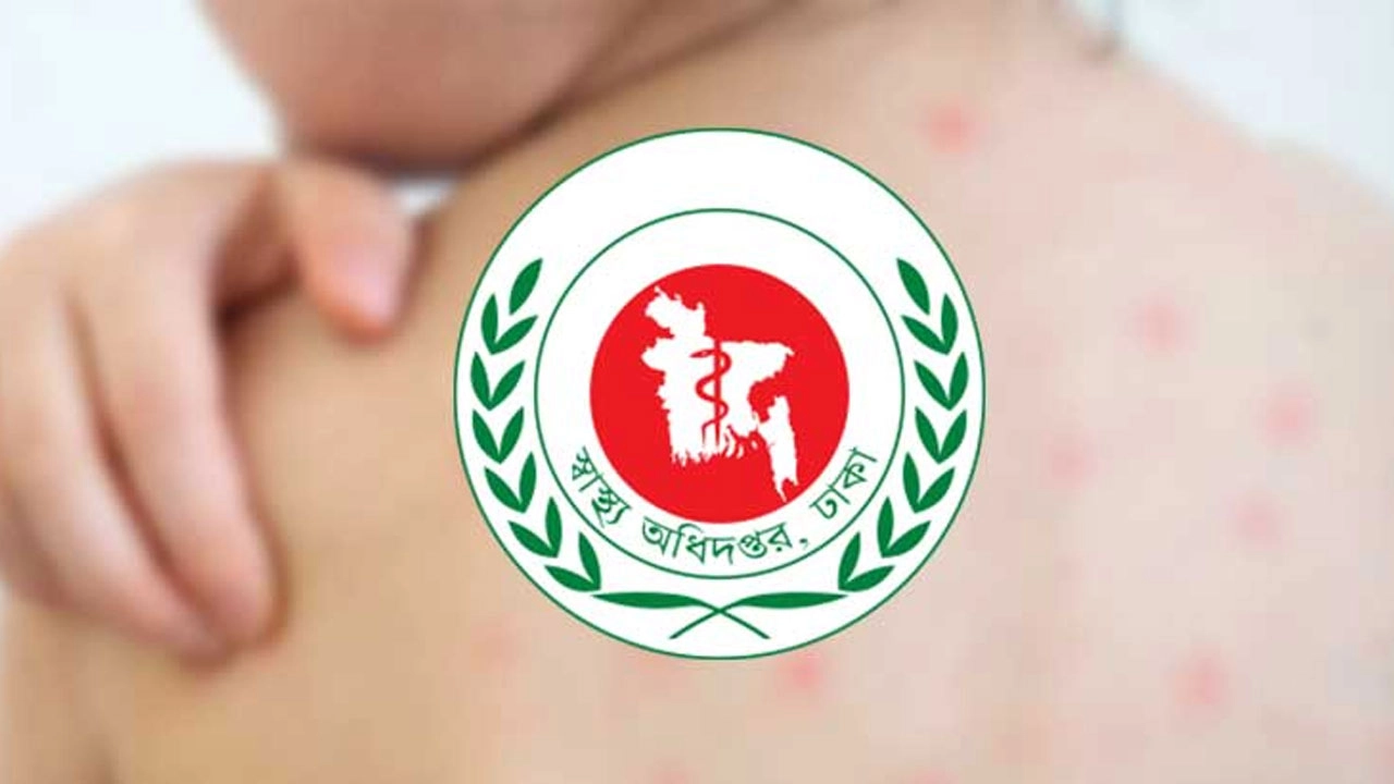 হাম ও হামের উপসর্গে আরও ৭ জনের মৃত্যু